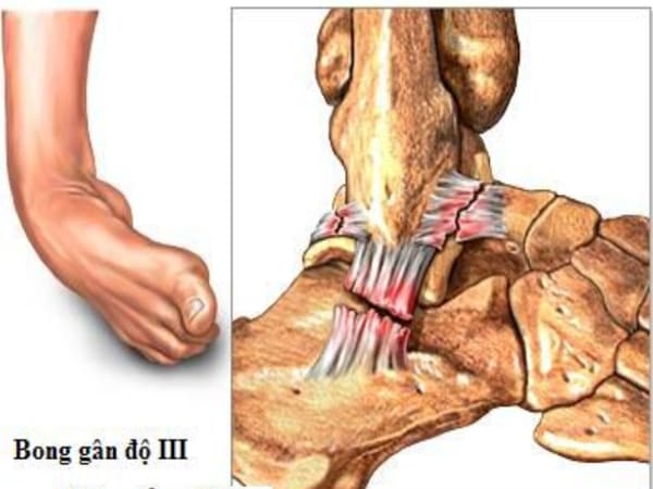 Bong gân – Phải làm gì nếu bạn bị bong gân